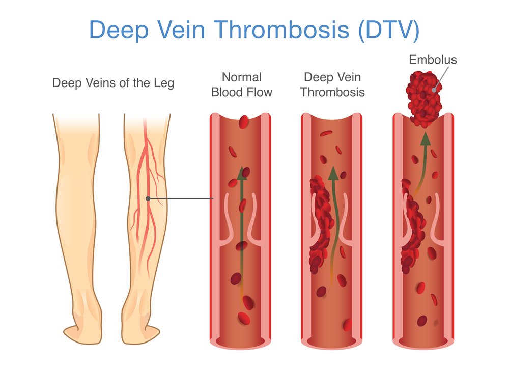 Acute Deep Vein Thrombosis DVT 