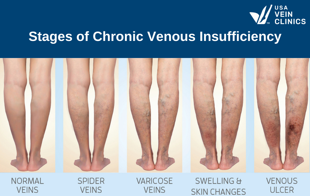 Chronic Venous Insufficiency (CVI), Department of Surgery