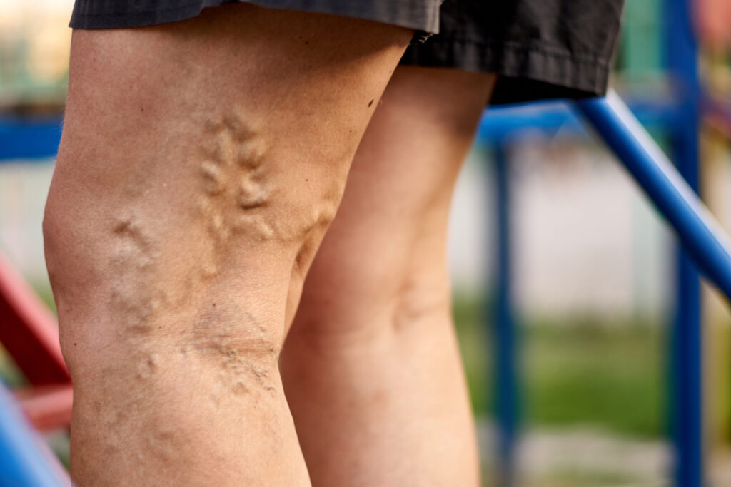 Varicose Veins vs. Spider Veins- What's the Difference